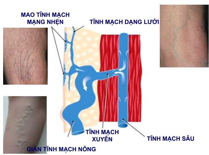 benh suy tinh mach chi duoi man tinh2