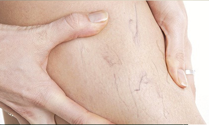 benh suy tinh mach chi duoi man tinh4