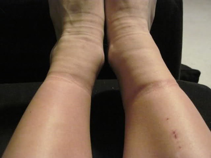 benh suy tinh mach chi duoi man tinh5