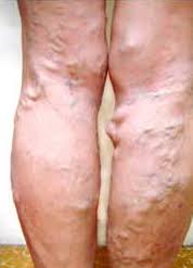 benh suy tinh mach chi duoi man tinh6